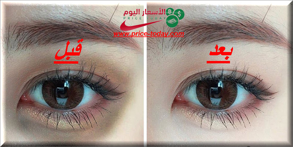 الهالات السوداء